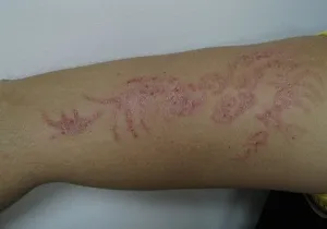 Alergia la tatuaj modul de a trata răspunsul negativ al corpului