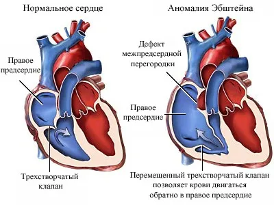 anomalie Ebstein - cauze, simptome și tratament