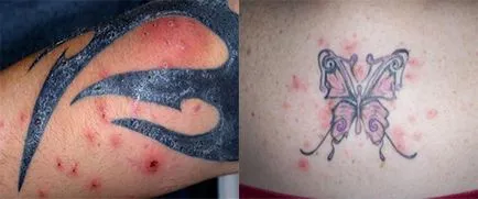 Alergia la tatuaj tatuaj de cerneală pe cauze, tratament