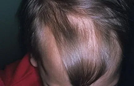Alopecia la copii cauze, diagnostic, tratament (foto, video)