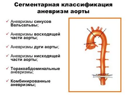 Anevrismul sau de extindere aortica simptome si tratament