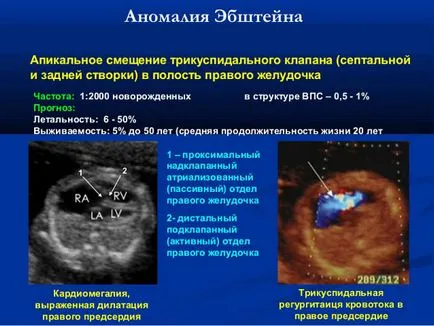 Ebstein на аномалия - причини, симптоми, лечение, възрастни, деца