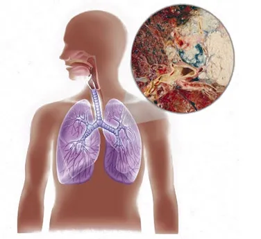 indicatii pulmonare biopsie (cancer, sarcoidoza), progresul și rezultatele