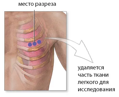 indicatii pulmonare biopsie (cancer, sarcoidoza), progresul și rezultatele