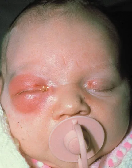 Офталмия при новородени - профилактика, симптоми, с нагледни примери за снимки и диаграми