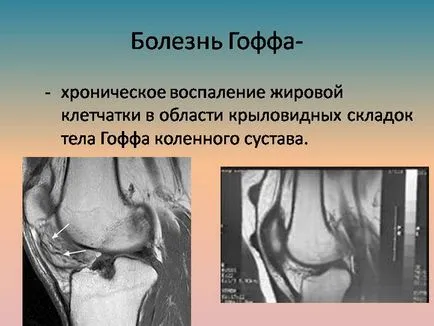 Hoff заболяване на колянната става - увреждане на органите на мазнини