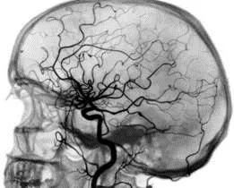 angiografia cerebrală - indicații, contraindicații și performanța echipamentelor