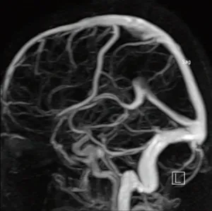 angiografia cerebrală vaselor cerebrale