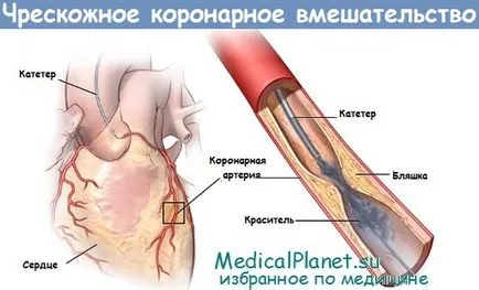 Перкутанна коронарна интервенция (PCI) в ангина