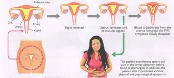 Ce este sindromul premenstrual la femei poze - sfaturi și răspunsuri