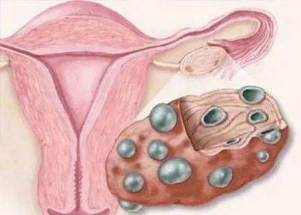 Ctress ciclu menstrual și efectul, întârziere lunar