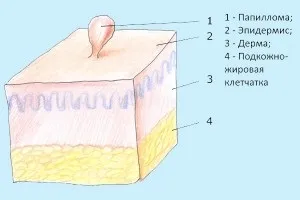 Кетамін від папілом відгуки та способи лікування