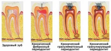 Класифікація форми і види періодонтиту (періодонтиту) Класифікація форми і види періодонтиту