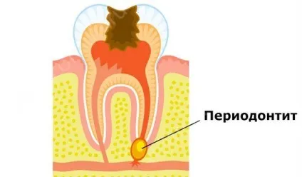 Класифікація форми і види періодонтиту (види) Класифікація форми і види періодонтиту
