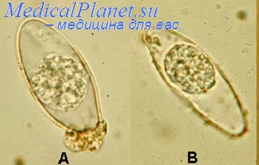 Диагностика и лечение на izosporiaza