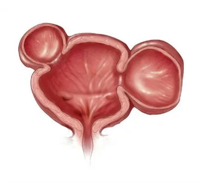 Diverticul de tratament vezicii urinare, care este diverticuloza si pseudo-diverticul