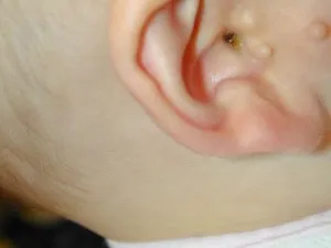 Secundar tragus - cauze, simptome, diagnostic, tratament