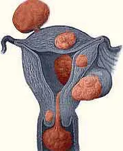 Fibrom uterin Simptome, Diagnostic, Tratament