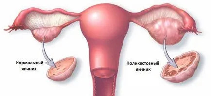 Fibromul uterin - ce este semne și simptome, tratament de atac folk
