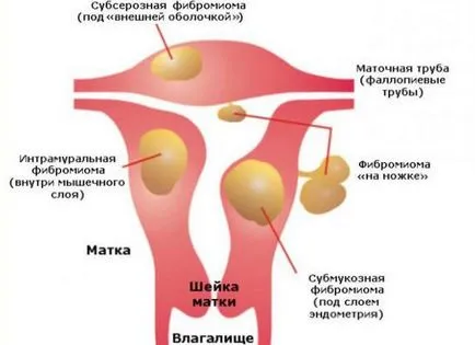 Fibromul uterin - ce este semne și simptome, tratament de atac folk