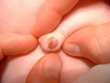 Фимоза при бебета, поради което е налице при новородените момчета, както и за признаци и симптоми
