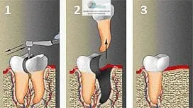 Полу-разрез на корена на зъба - ампутация на корени, цените и разходите, методи на работа, индикации и