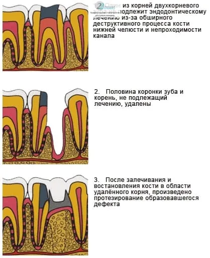 Полу-разрез на корена на зъба - ампутация на корени, цените и разходите, методи на работа, индикации и