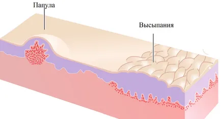 Haemangioma a bőr felnőtteknél okoz, mint veszélyes