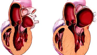 Hipertensiunea, ventriculul stang - tratamentul cardiac