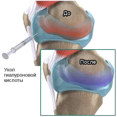 Acidul hialuronic pentru un efect comun a modului în care să se aplice, de lectură