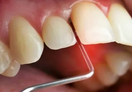 Гингивектомия в единични и множество зъби