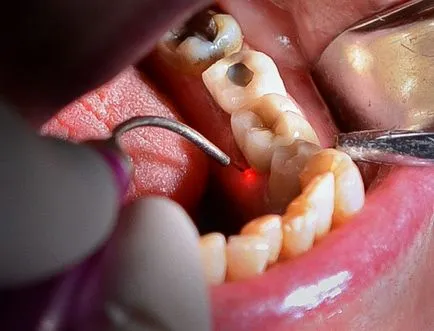 Gingivectomy egyszeri és többszöri fogak