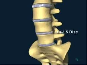 Hernia a coloanei vertebrale lombare