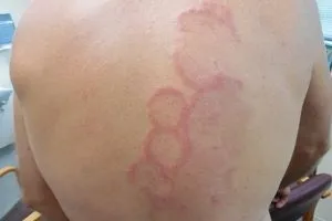 Кільцеподібна еритема у дітей причини, симптоми і лікування