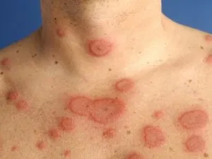 Кільцеподібна еритема у дітей причини, симптоми і лікування