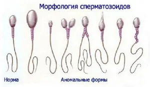 Mi legyen a sperma sűrű folyadék, viszkózus, mag színe, amely meghatározza a sűrűség