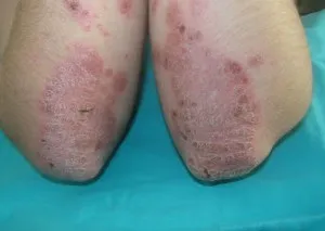 Amint kiveszi a psoriasis súlyosbodása