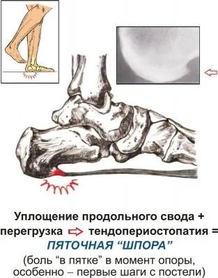 Как да се отървем от Спърс (шипове) на краката