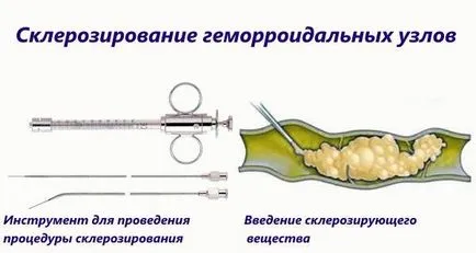 Как и какво да се явят на хемороиди