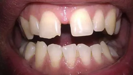 Cum de a stabili diferența dintre dinții din față