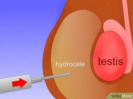 Cum de a trata hidropizie