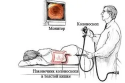 Як роблять колоноскопію кишечника