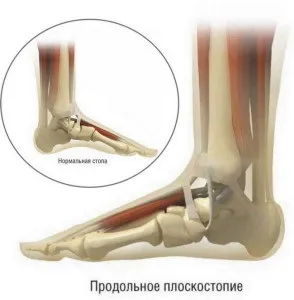 Як ефективно вилікувати плоскостопість 2 ступеня - причини, характерні особливості плоскостопості (плоскостопість) Як ефективно вилікувати плоскостопість 2 ступеня - причини, характерні особливості плоскостопості