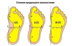 Як ефективно вилікувати плоскостопість 2 ступеня - причини, характерні особливості плоскостопості (плоскостопість) Як ефективно вилікувати плоскостопість 2 ступеня - причини, характерні особливості плоскостопості