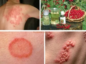 Які народні засоби використовують для лікування лишаю, мій знахар (висівковий лишай) Які народні засоби використовують для лікування лишаю, мій знахар