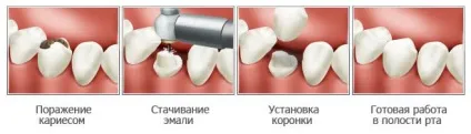 Які коронки краще ставити на зуби