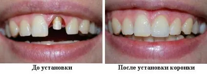 Які коронки краще ставити на зуби