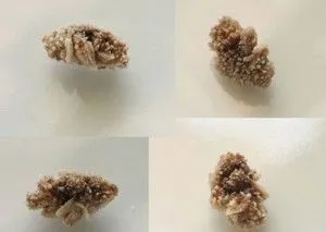Коралоподібні камені в нирках лікування і способи видалення (нирках) Коралоподібні камені в нирках лікування і способи видалення