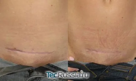 Cum de a elimina cicatrice (cicatrice) dupa cezariana - unguente, laser resurfacing, tatuaje, plastic și alte