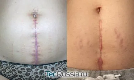 Cum de a elimina cicatrice (cicatrice) dupa cezariana - unguente, laser resurfacing, tatuaje, plastic și alte